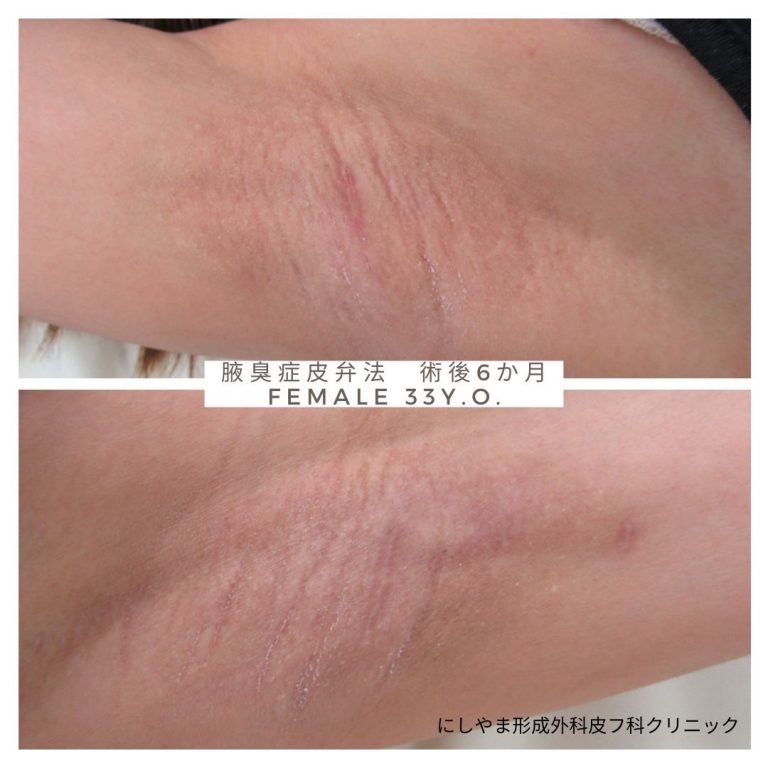 わきが（腋臭症）切開剪除手術/にしやま形成外科皮フ科クリニック（名古屋栄3丁目） - 名古屋市中区「にしやま形成外科皮フ科クリニック」
