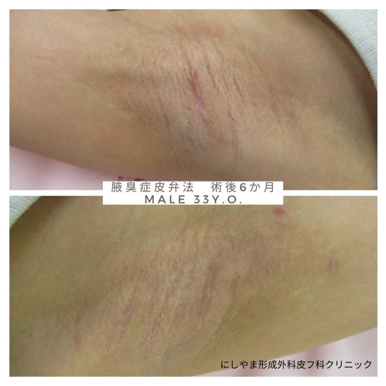 わきが（腋臭症）切開剪除手術/にしやま形成外科皮フ科クリニック（名古屋栄3丁目） - 名古屋市中区「にしやま形成外科皮フ科クリニック」