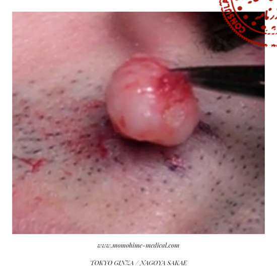 皮膚混合腫瘍1-4.jpg