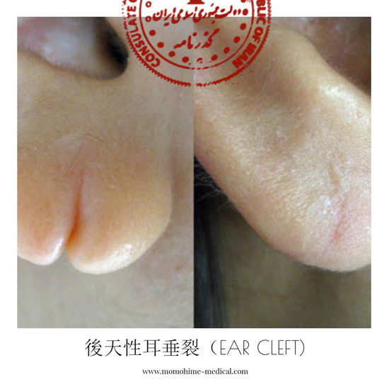 ear-cleft-nishiyama2.jpg