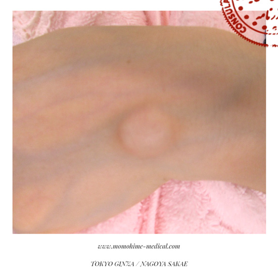 ganglion-nishiyama1-1.jpg