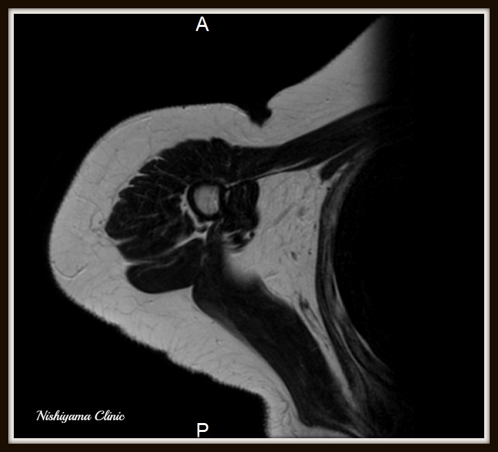 lopoma mri.jpg