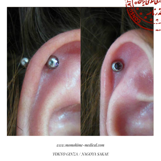 medical-piercing-nishiyama3.jpg